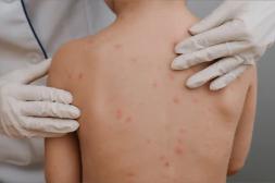 Casos de varicela se duplicaron en 2025, con fuerte incidencia en los jóvenes y en menores de cinco años