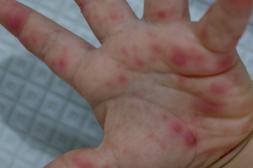 Aumentan cuadros por virus  “manos-pies-boca” en niños