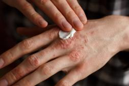 Psoriasis: los mitos que mantienen el estigma y los riesgos de no tener un diagnóstico de la enfermedad