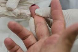 Alertan por detección de  casos de “sífilis terciaria”